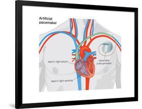 Artificial Pacemaker-Encyclopaedia Britannica-Framed Poster