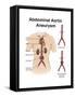 Artist Depcition of Abdominal Aortic Aneuryism (With Labels)-null-Framed Stretched Canvas