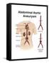 Artist Depcition of Abdominal Aortic Aneuryism (With Labels)-null-Framed Stretched Canvas