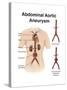 Artist Depcition of Abdominal Aortic Aneuryism (With Labels)-null-Stretched Canvas