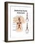 Artist Depcition of Abdominal Aortic Aneuryism (With Labels)-null-Framed Art Print