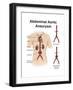 Artist Depcition of Abdominal Aortic Aneuryism (With Labels)-null-Framed Art Print