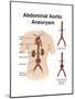 Artist Depcition of Abdominal Aortic Aneuryism (With Labels)-null-Mounted Art Print