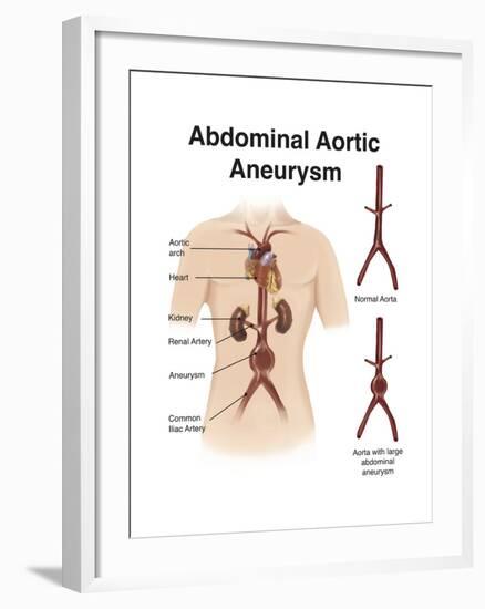 Artist Depcition of Abdominal Aortic Aneuryism (With Labels)-null-Framed Art Print