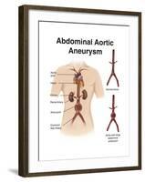 Artist Depcition of Abdominal Aortic Aneuryism (With Labels)-null-Framed Art Print