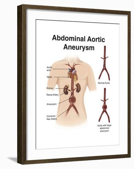 Artist Depcition of Abdominal Aortic Aneuryism (With Labels)-null-Framed Art Print