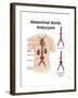 Artist Depcition of Abdominal Aortic Aneuryism (With Labels)-null-Framed Art Print