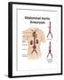Artist Depcition of Abdominal Aortic Aneuryism (With Labels)-null-Framed Art Print