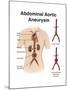 Artist Depcition of Abdominal Aortic Aneuryism (With Labels)-null-Mounted Art Print