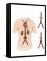 Artist Depcition of Abdominal Aortic Aneuryism-null-Framed Stretched Canvas