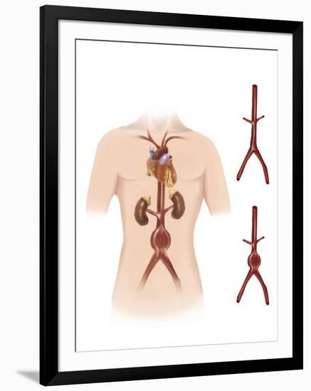 Artist Depcition of Abdominal Aortic Aneuryism-null-Framed Art Print