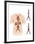 Artist Depcition of Abdominal Aortic Aneuryism-null-Framed Art Print