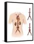 Artist Depcition of Abdominal Aortic Aneuryism-null-Framed Stretched Canvas