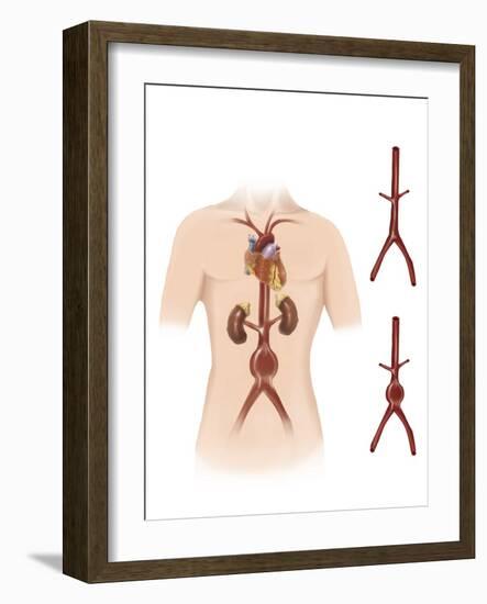 Artist Depcition of Abdominal Aortic Aneuryism-null-Framed Art Print