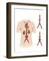 Artist Depcition of Abdominal Aortic Aneuryism-null-Framed Art Print