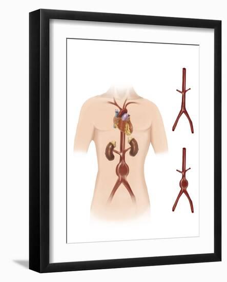 Artist Depcition of Abdominal Aortic Aneuryism-null-Framed Art Print