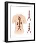 Artist Depcition of Abdominal Aortic Aneuryism-null-Framed Art Print