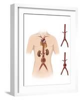 Artist Depcition of Abdominal Aortic Aneuryism-null-Framed Art Print