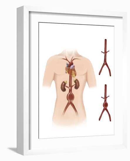 Artist Depcition of Abdominal Aortic Aneuryism-null-Framed Art Print