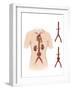 Artist Depcition of Abdominal Aortic Aneuryism-null-Framed Art Print