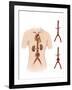 Artist Depcition of Abdominal Aortic Aneuryism-null-Framed Art Print