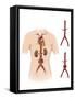 Artist Depcition of Abdominal Aortic Aneuryism-null-Framed Stretched Canvas