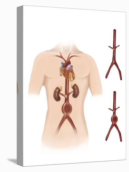 Artist Depcition of Abdominal Aortic Aneuryism-null-Stretched Canvas