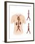 Artist Depcition of Abdominal Aortic Aneuryism-null-Framed Art Print