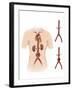 Artist Depcition of Abdominal Aortic Aneuryism-null-Framed Art Print