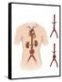 Artist Depcition of Abdominal Aortic Aneuryism-null-Framed Stretched Canvas