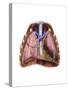 Artist Depiction of Mesothelioma in the Lungs-Abdominal Cavity-null-Stretched Canvas