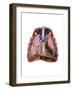 Artist Depiction of Mesothelioma in the Lungs-Abdominal Cavity-null-Framed Art Print