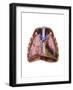 Artist Depiction of Mesothelioma in the Lungs-Abdominal Cavity-null-Framed Art Print