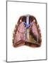 Artist Depiction of Mesothelioma in the Lungs-Abdominal Cavity-null-Mounted Art Print