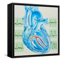 Artwork of Cardiac Arrhythmia with Heart & ECGs-John Bavosi-Framed Stretched Canvas