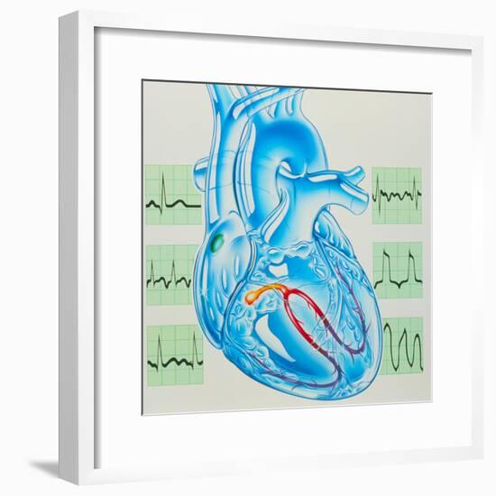 Artwork of Cardiac Arrhythmia with Heart & ECGs-John Bavosi-Framed Premium Photographic Print