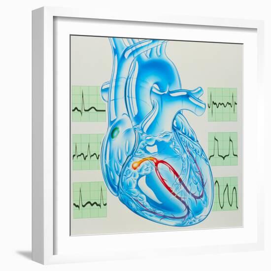 Artwork of Cardiac Arrhythmia with Heart & ECGs-John Bavosi-Framed Premium Photographic Print