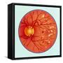 Artwork of Diabetic Retinopathy Ophthalmoscope View-John Bavosi-Framed Stretched Canvas