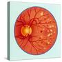 Artwork of Diabetic Retinopathy Ophthalmoscope View-John Bavosi-Stretched Canvas