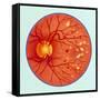 Artwork of Diabetic Retinopathy Ophthalmoscope View-John Bavosi-Framed Stretched Canvas