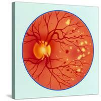 Artwork of Diabetic Retinopathy Ophthalmoscope View-John Bavosi-Stretched Canvas
