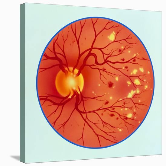 Artwork of Diabetic Retinopathy Ophthalmoscope View-John Bavosi-Stretched Canvas