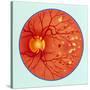 Artwork of Diabetic Retinopathy Ophthalmoscope View-John Bavosi-Stretched Canvas