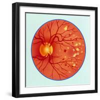 Artwork of Diabetic Retinopathy Ophthalmoscope View-John Bavosi-Framed Premium Photographic Print