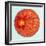 Artwork of Diabetic Retinopathy Ophthalmoscope View-John Bavosi-Framed Premium Photographic Print