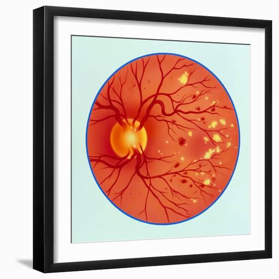 Artwork of Diabetic Retinopathy Ophthalmoscope View-John Bavosi-Framed Premium Photographic Print