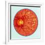 Artwork of Diabetic Retinopathy Ophthalmoscope View-John Bavosi-Framed Photographic Print