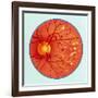 Artwork of Diabetic Retinopathy Ophthalmoscope View-John Bavosi-Framed Photographic Print