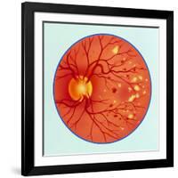 Artwork of Diabetic Retinopathy Ophthalmoscope View-John Bavosi-Framed Photographic Print