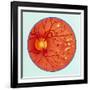 Artwork of Diabetic Retinopathy Ophthalmoscope View-John Bavosi-Framed Photographic Print